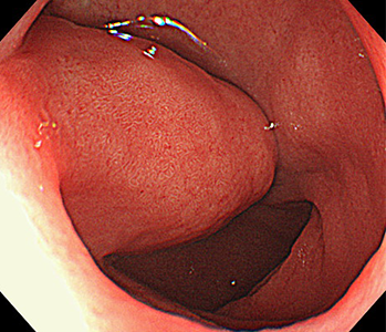 十二指腸ブルンネル腺過形成