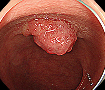 大腸（S状結腸）に14mm大のポリープ