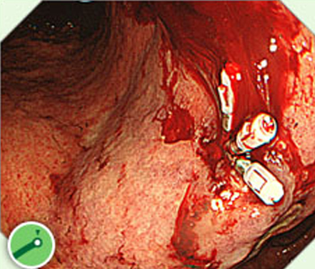 胃潰瘍内の血管からの出血